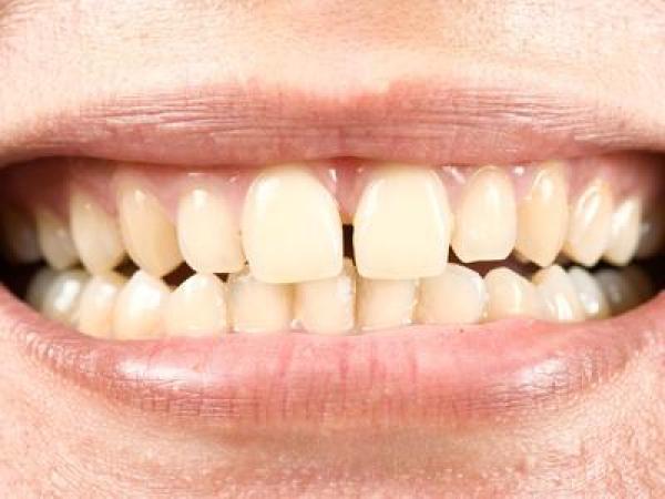 Diastema Closure (Closing the space between teeth)