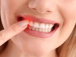 Diş Eti Hastalıkları ve Tedavisi (Periodontoloji)