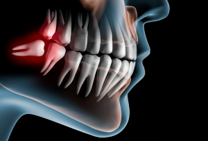 Kemik Transferi Ve Gömülü Diş Çekimleri (Çene Cerrahisi)